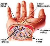 Carpal Tunnel Syndrome